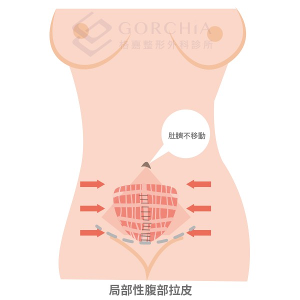 局部腹部拉皮手術